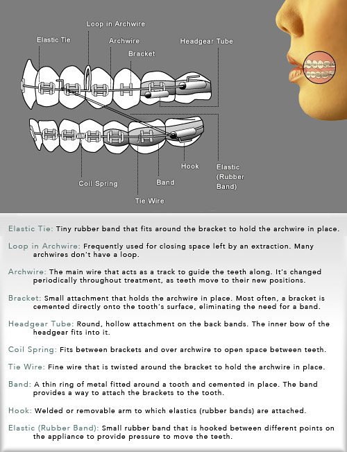 Braces Diagram