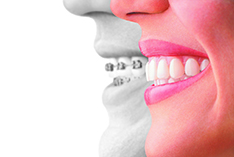 Invisalign Profile