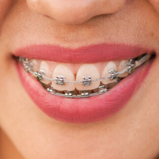 Silver braces bands discount