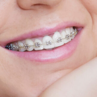 Traditional Braces - Corvallis orthodontist, Albany orthodontist, Newport orthodontist, Lebanon orthodontist, Orthodontist near me, Eugene orthodontist, Florence orthodontist