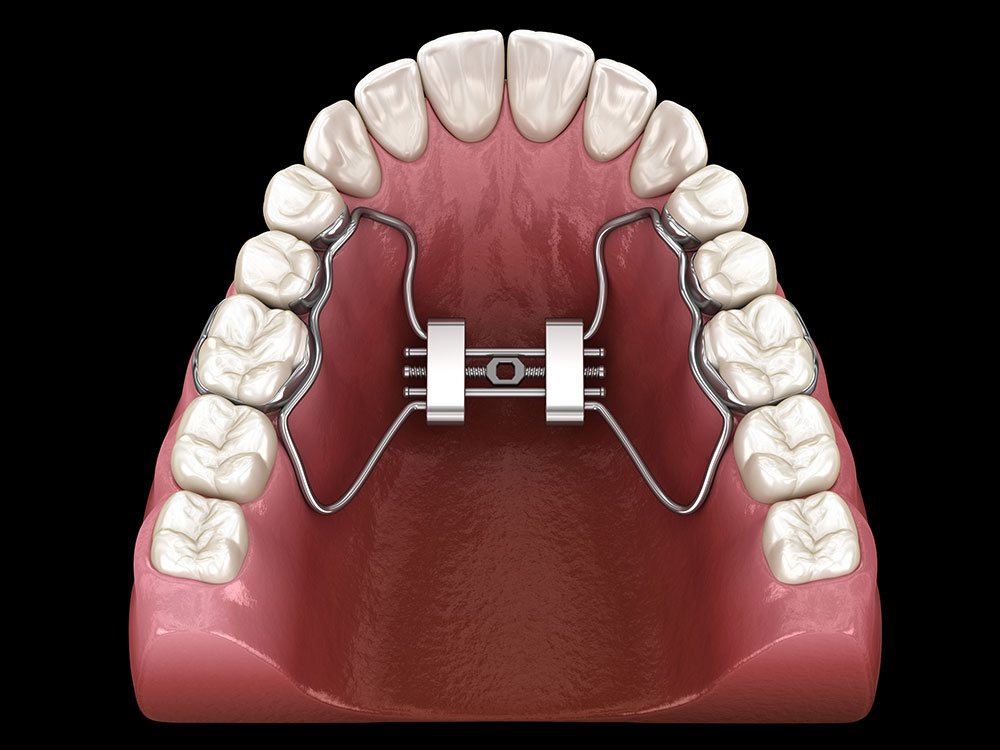 Palatal Expander-NW Washington DC Orthodontist